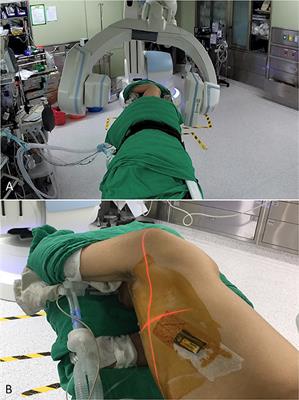 Individualized Strategies for Intraoperative Localization of Non-palpable Pulmonary Nodules in a Hybrid Operating Room